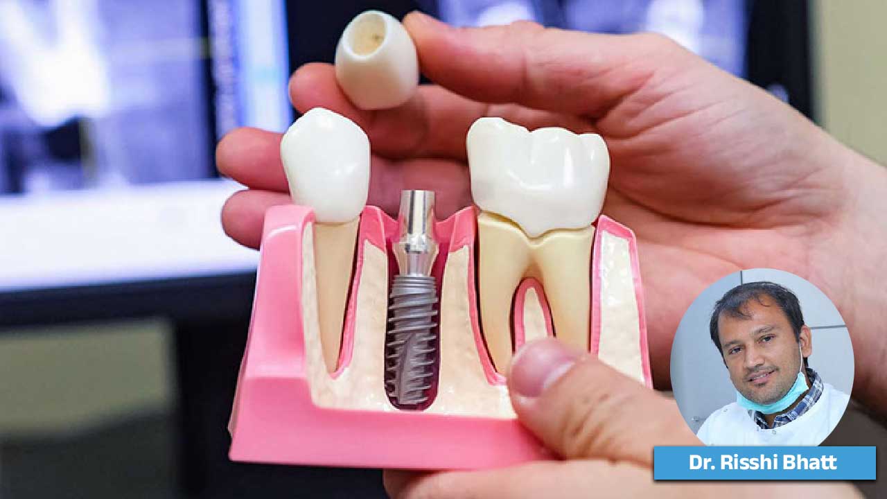 A Single Missing Tooth Might Cost You Much More Than You Think