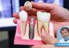 A Single Missing Tooth Might Cost You Much More Than You Think