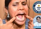 26-Year-Old Indian Woman Sets Record with 38 Teeth — Should Extra Teeth Be Removed?