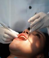 Brushing for Brain Health: Studies Link Gum Disease to Stroke Risk