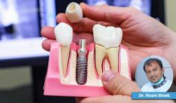A Single Missing Tooth Might Cost You Much More Than You Think