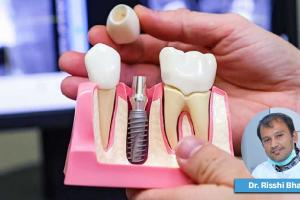 A Single Missing Tooth Might Cost You Much More Than You Think